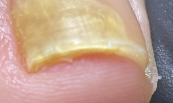 Первинний подологічний педікюр 2.ст.складності (з обробкою оніхолиза/мозолі/тріщіни) Центри подології Calutte Харків