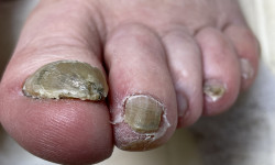 Медичний педикюр 3 ст. складності (наявність інфекціі) Центри подології Calutte Харків