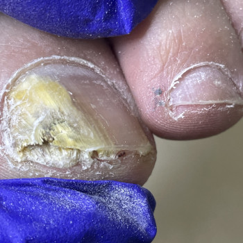 Медицинский педикюр 4 ст. сложности (наявність інфекціі)
                    Центри подології Calutte Харків