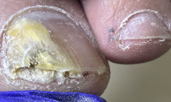 Медицинский педикюр 4 ст. сложности (наявність інфекціі) Центры подологии Calutte Харьков