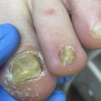 Медицинский педикюр 4 ст. сложности (наявність інфекціі)
                    Центри подології Calutte Харків