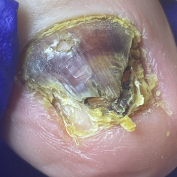 Медицинский педикюр 4 ст. сложности (наявність інфекціі)
                    Центри подології Calutte Харків