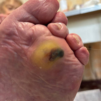 Медицинский педикюр 4 ст. сложности (наявність інфекціі)
                    Центри подології Calutte Харків