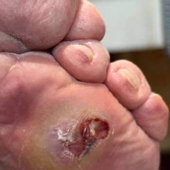 Медицинский педикюр 4 ст. сложности (наявність інфекціі)
                    Центри подології Calutte Харків