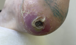 Перев'язка та обробка діабетичної виразки (з розвантаженням) Центры подологии Calutte Харьков