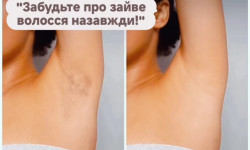 Лазерная эпиляция Харьков Холодная гора Косметолог-инъекционист Ольга Харьков