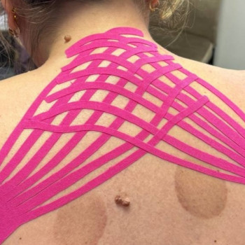 Лімфодренажне тейпуваня холки.