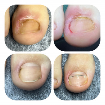 Неправильно зрізані нігті, призводять до вростання . Перший візит 8.11 обработано, назначено домашні...