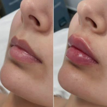 💉 Справа не у формі, а у розмірі 💋

Багато хто приходить «просто трошки додати об’єму».
Але гармо...