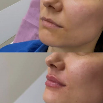 💉 Справа не у формі, а у розмірі 💋

Багато хто приходить «просто трошки додати об’єму».
Але гармо...