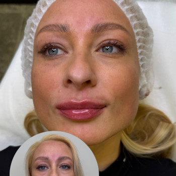 Stylage M

Присутній набряк, після загоєння губи виглядатимуть максимально природньо