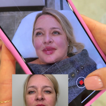 Neuramis Deep
Відновили втрачений обʼєм.

На фото присутній набряк