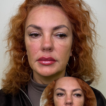 Neuramis Deep

Додали обʼєму, вирівняли асиметрію, присутній набряк.