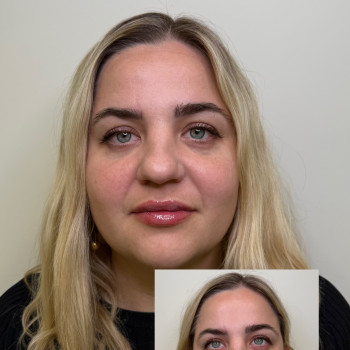 Jevederm 3

На фото присутні набряк і гематоми. період загоєння до 14 днів.

Запит на максимальн...