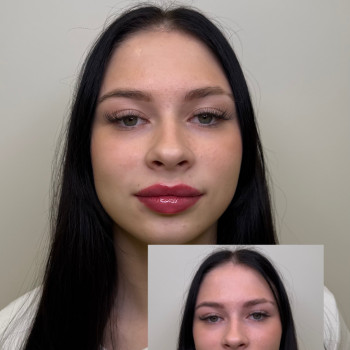 Neuramis Deep

Запит на зволоження і виправлення асиметрії 

Присутній набряк