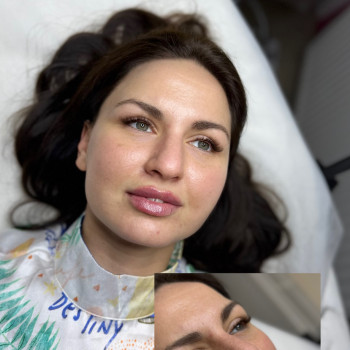 Stylage Lips Plus

Запит на максимально природній результат, виправлення асиметрії

Присутній на...