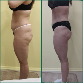 Кавітація живіт+ Вібросфера