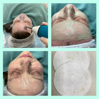 Чистка обличчя менанічна та УЗ.