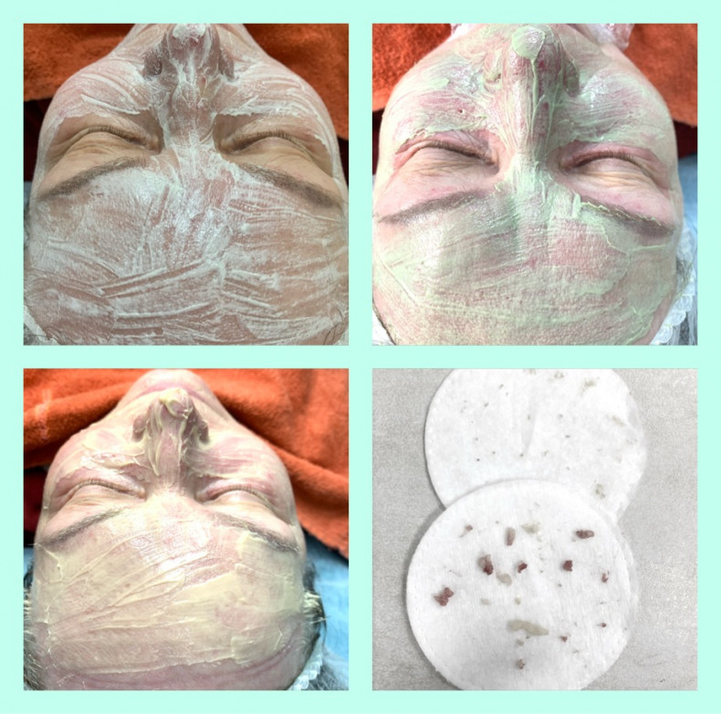 Комбінована чистка обличчя, фото - Майстер з пірсингу Тетяна Ананьєва