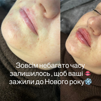 Збільшення губ 1 мл сертифіковані препарати