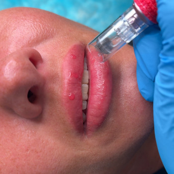 Мікронідлінг губ: hydralips