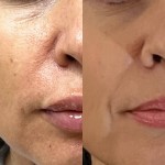 КОНТУРНА ПЛАСТИКА НОГОГУБНИХ СКЛАДОК Дерматолог косметолог Нелли Київ