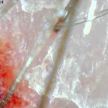 Себорейний дерматит