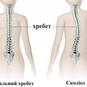 Масаж при сколіозі 1 ступеня
                    Мануальный терапевт Олег Киев