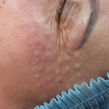 Биоревитализация зоны вокруг глаз
                    Косметолог Анастасия Днепр