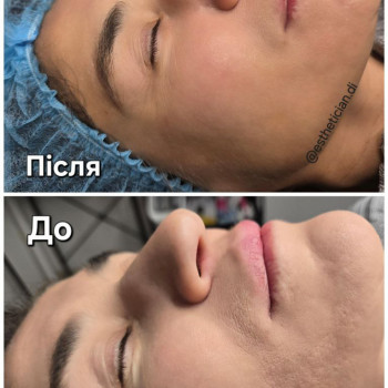 Карбокситерапія