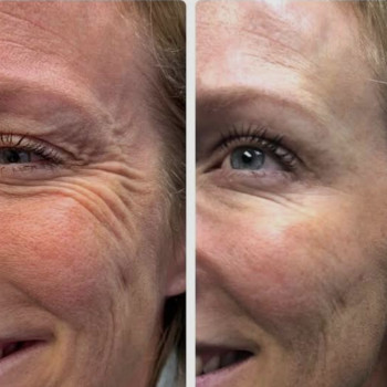 Що таке ботокс?
Ботулотоксин — препарат, що розслабляє м’язи та згладжує зморшки.
Результат — біль...