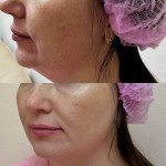 Біоревіталізація Дерматолог косметолог Нелли Киев