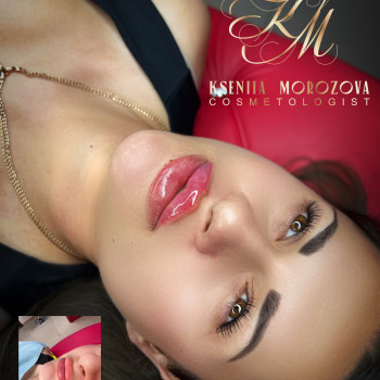 Збільшення губ
                    Косметолог Ксенія Житомир