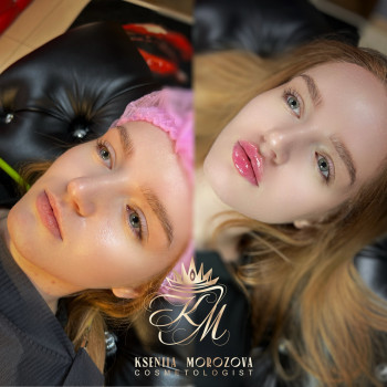 Збільшення губ
                    Косметолог Ксенія Житомир