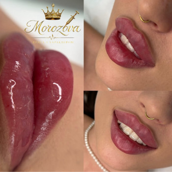 Збільшення губ
                    Косметолог Ксенія Житомир