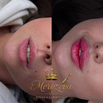 Збільшення губ
                    Косметолог Ксенія Житомир