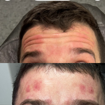 Ботокс для чоловіків та жінок для обличчя без зморшок