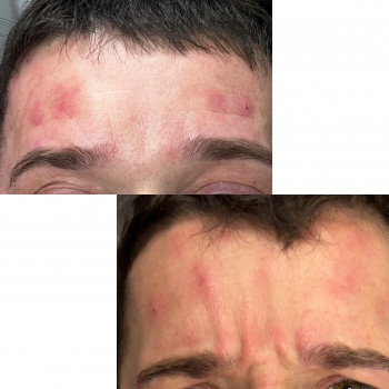 Ботокс для чоловіків та жінок для обличчя без зморшок