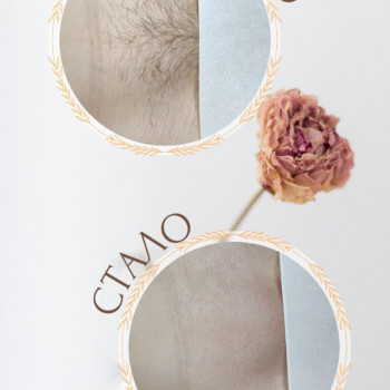 Фото одразу після процедури. Без крові та почервоніння😇