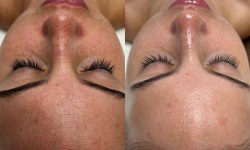 Карбокситерапия Мастер депиляции Ирина Киев