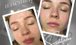 Аугментація губ(контурна пластика) Косметолог-эстетист Светлана Харьков