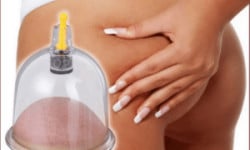 Антицеллюлитный массаж баночный Косметолог Виктория Николаев