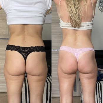 Зроблено 4 сеанси антицелюлітного масажу