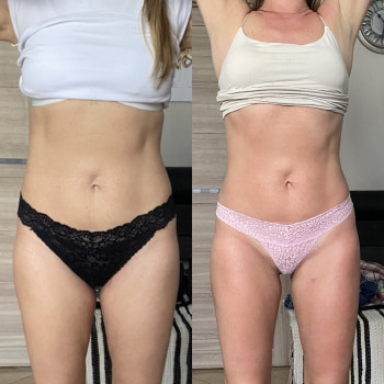 Зроблено 4 сеанси антицелюлітного масажу