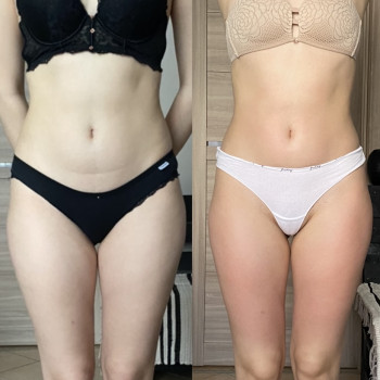 Зроблено 2 сеанси антицелюлітного масажу.Прибралися набряки на животі та стегнах