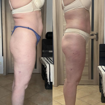 Зроблено 10 сеансів антицелюлітного масажу та 8 сеансів загального масажу.
Клієнтка прийшла з масою...