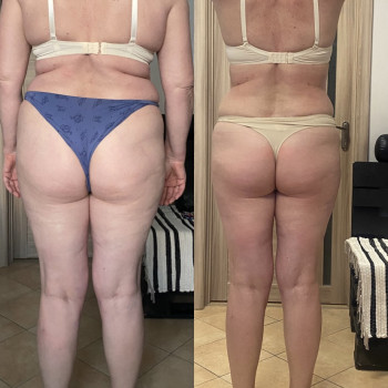 Антицелюлітний масаж в поєднанні з загальним масажем