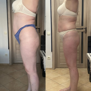 Антицелюлітний масаж в поєднанні з загальним масажем