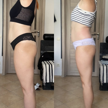 Зроблено 10 сеансів антицелюлітного масажу