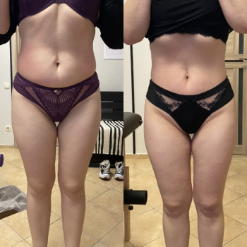 Зроблено 12 сеансів антицелюлітного масажу